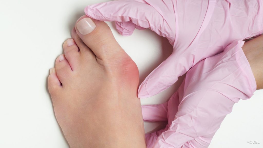 Woman having bunions treated by a doctor (models)