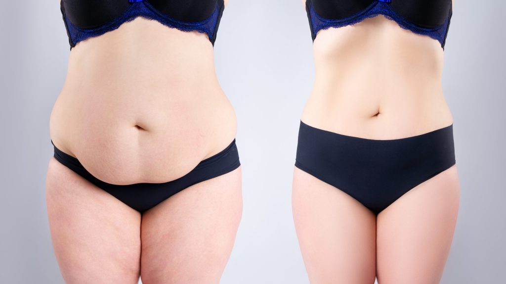 loose skin after weight loss