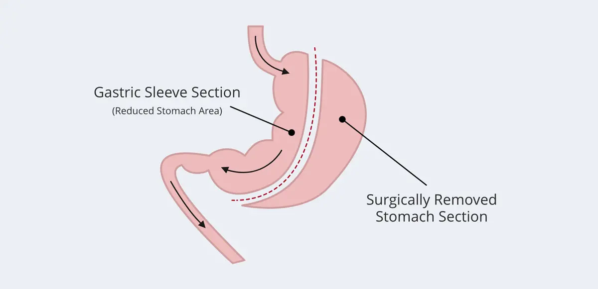 Diagram showing portion of stomach removed and gastric sleeve section left after procedure