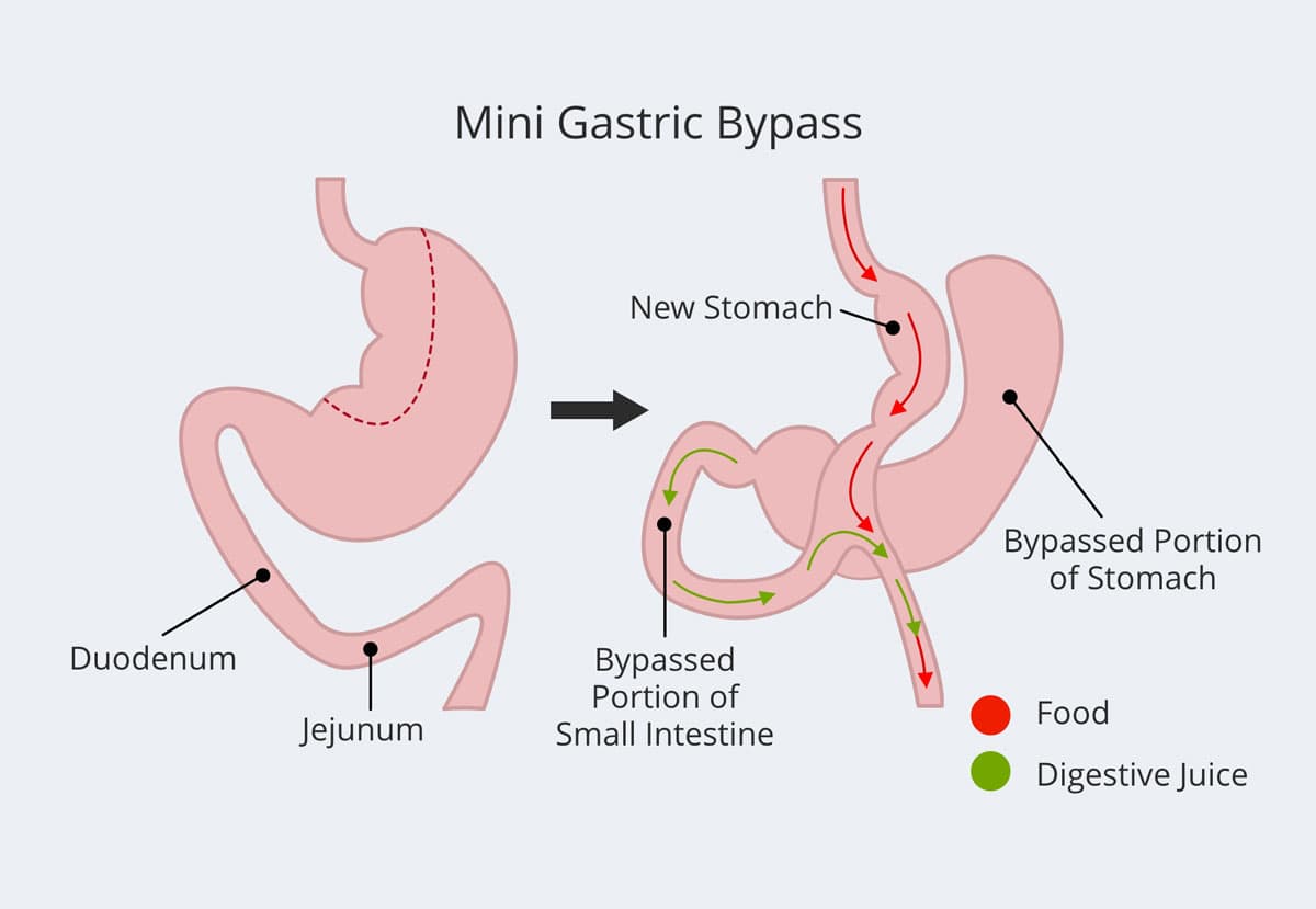 Diagram showing how a gastric bypass surgery divides stomach